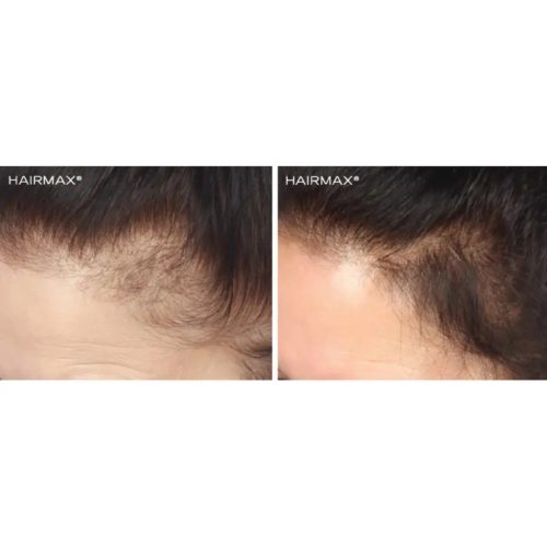 HairMax lazerinis plaukų lankelis LASERBAND 41 ComfortFlex LASERBAND